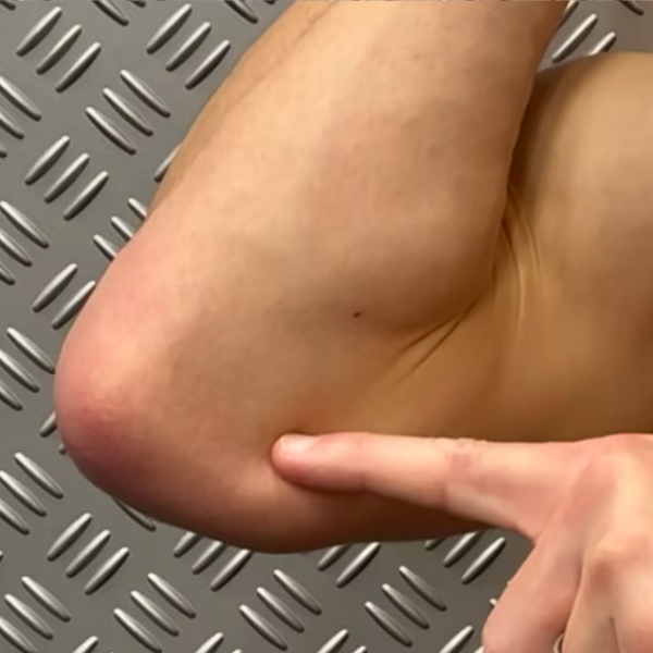 Elbow Pain (Medial), illustration