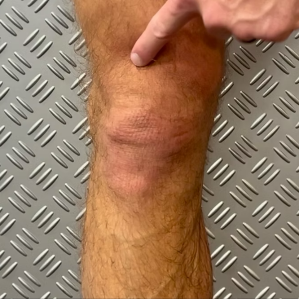 Knee Pain (Femoral), illustration