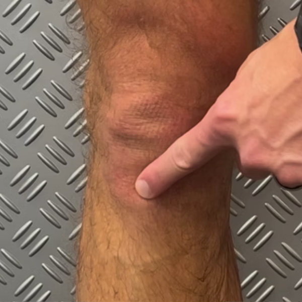Knee Pain (Tibial), illustration